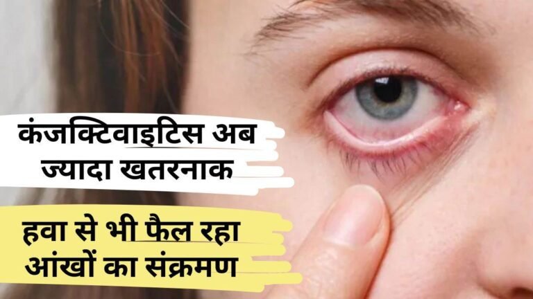 Conjunctivitis Alert: कंजक्टिवाइटिस से हो रहा कॉर्निया अल्सर, लापरवाही बरती तो जा सकती है आंखों की रोशनी