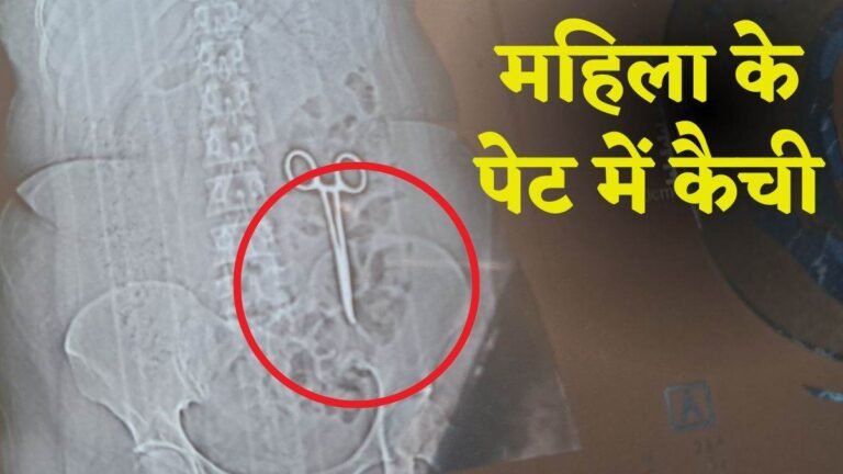 महिला के पेट में निकली कैंची; दर्द होने पर कराया  CT Scan  तो रह गए दंग, 2 साल पहले हुआ था ऑपरेशन