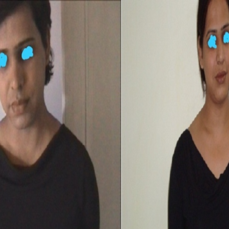 6 महीने में पुरुष बन जाते हैं महिला:बॉडी पार्ट बदल दिए जाते हैं, आवाज भी; रायपुर में 120 ऐसी सर्जरी, मां भी बने