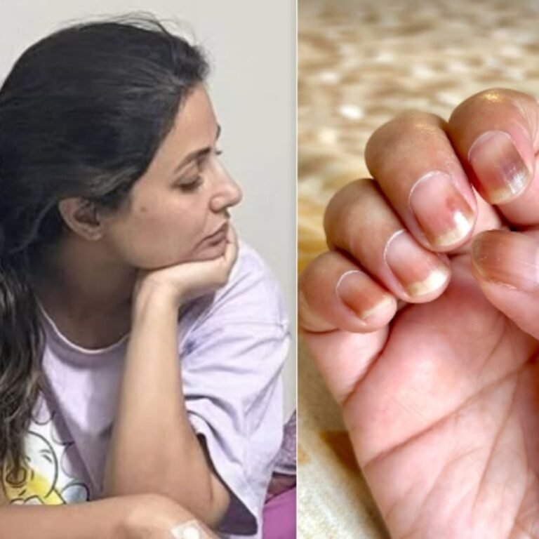 कीमोथैरेपी से सूख गए हिना खान के नाखून:एक्ट्रेस बोलीं, ये साइड इफेक्ट है कभी-कभी ये नाखून उखड़ भी जाते हैं, खुशी है ये सब टेंपरेरी है