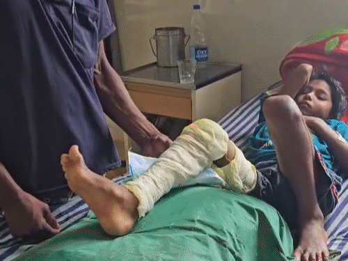 हेडमास्टर ने कक्षा-2 की छात्रा को डंडे से पीटा...पैर फ्रैक्चर:3 दिन से अस्पताल में भर्ती, शिक्षक पर एक्शन नहीं, BEO बोले- शिकायत नहीं मिली