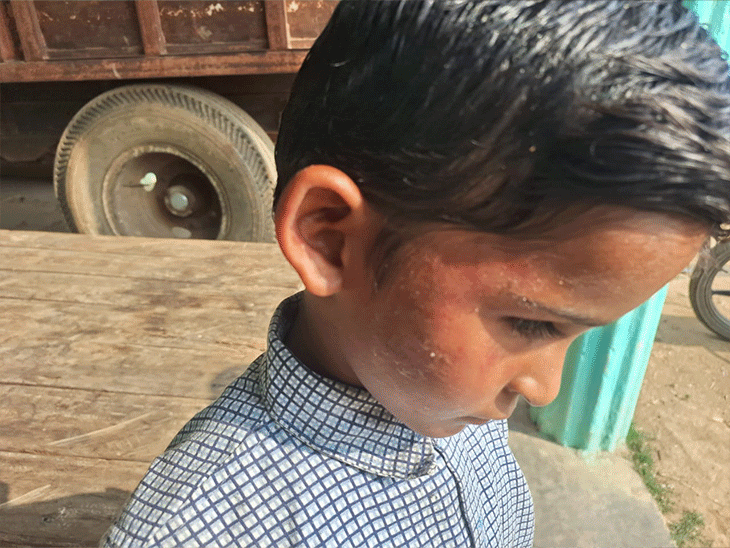 टीचर की पिटाई से आंखों में आया खून, चेहरा सूजा:बच्चे से गिनती सुनाने में हुई थी गलती, परिजन बोले-नशे में स्कूल आते हैं प्रिंसिपल