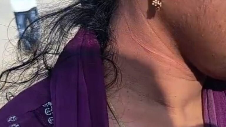 बड़वानी में स्‍कूटी सवार महिला के गले में अटका चाइनीज मांझा, घायल