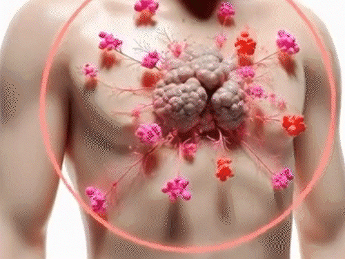 11 साल के मासूम को इनवेसिव थायमिक कैंसर:8 महीने में हो जाती मौत, मेकाहारा में सक्सेफुल सर्जरी; 10 करोड़ में एक को होता है